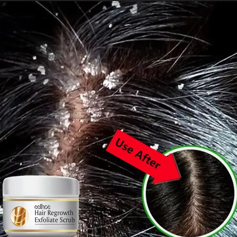 Fast Anti Exfoliating Scrub Remove Dandruff Anti Itching
